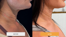 Load image into Gallery viewer, Exosome Therapy: Full Areas - Face, Neck or Chest (One Treatment)