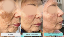 Load image into Gallery viewer, Exosome Therapy: Full Areas - Face, Neck or Chest  (COURSE OF 3) INTRO OFFER: SAVE £300