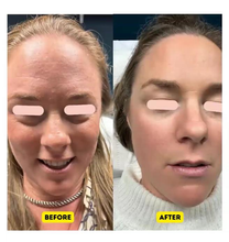 Load image into Gallery viewer, Exosome Therapy: Full Areas - Face, Neck or Chest  (COURSE OF 3) INTRO OFFER: SAVE £300