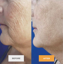 Load image into Gallery viewer, Exosome Therapy: Full Areas - Face, Neck or Chest  (COURSE OF 3) INTRO OFFER: SAVE £300