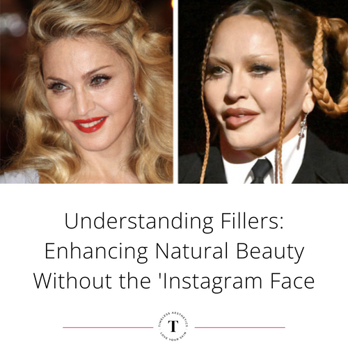 Understanding Fillers: Enhancing Natural Beauty Without the 'Instagram Face
