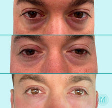 Load image into Gallery viewer, Exosome Therapy: Isolated Areas - Eyes or Lips (COURSE OF 3) INTRO OFFER: SAVE £150

